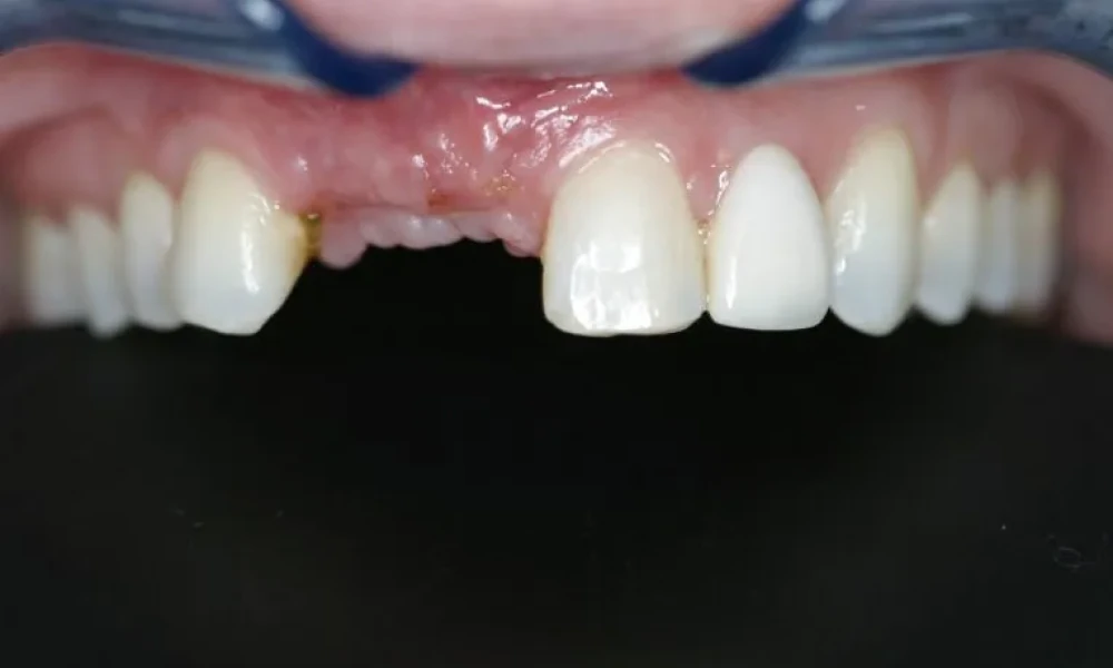 Clinical photo from Hope's smile reconstruction case